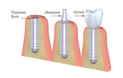 Chọn thời điểm thích hợp để cấy ghép implant