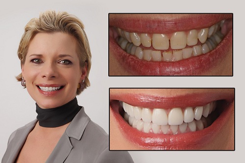 Đôi điểm về niềng răng invisalign