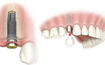 Giải pháp trồng răng giả nhân tạo có độ bền cao nhất