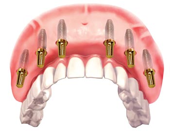Kết hợp implant và cầu răng sứ khi mất răng toàn hàm