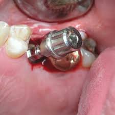 Một vài rủi ro khi cấy ghép implant