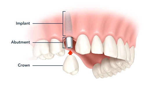 Tại sao cần thay thế nay các răng bị mất