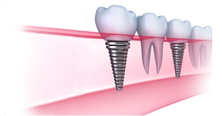 Trồng răng giả vĩnh viễn với implant nha khoa