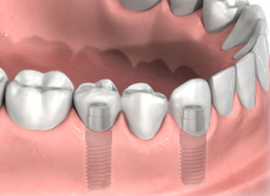 Trồng răng implant nha khoa có lâu không