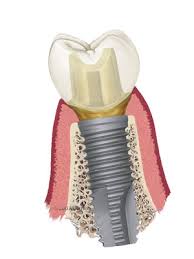 Cấy ghép răng implant là gì