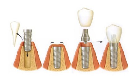 Có thể ghép xương và cấy implant cùng lúc được không?