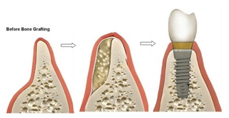 Có thể ghép xương và cấy implant cùng lúc được không?