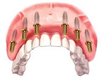 Làm răng giả cố định bằng implant và cầu răng