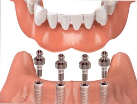 Làm răng giả cố định bằng implant và cầu răng