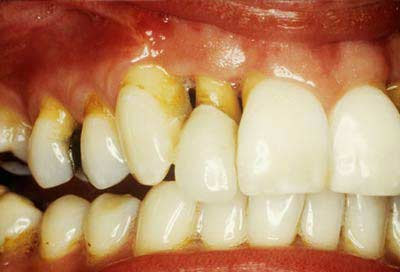 Mất răng do nha chu có cấy ghép implant được không?