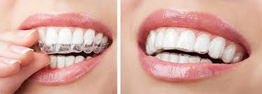 Một số vấn đề cần biết khi lựa chọn niềng răng invisalign