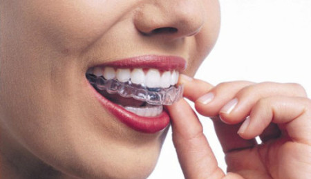 Những điểm lợi ích có thể cải thiện nhờ niềng răng