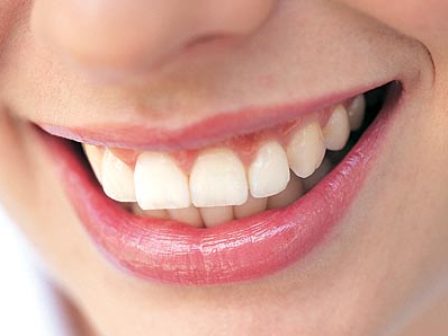 Răng bị sâu có tẩy trắng răng được không?