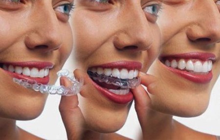 Sử dụng invisalign nắn chỉnh răng lệch lạc hiệu quả không?