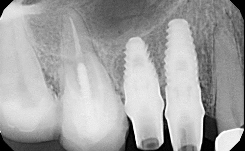  Ưu điểm phục hình răng cấy ghép implant 