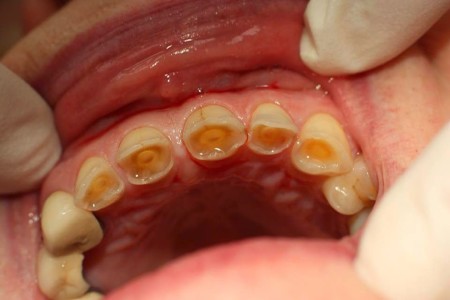 Hàm răng bị mòn mặt nhai có cải thiện được không?