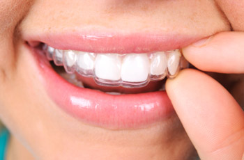 Khắc phục răng hô bằng giải pháp niềng răng invisalign