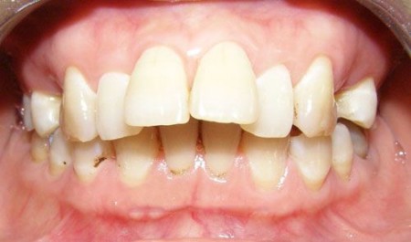 Khắc phục răng hô bằng giải pháp niềng răng invisalign