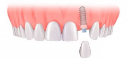 Mất răng cửa có trồng răng implant được không?