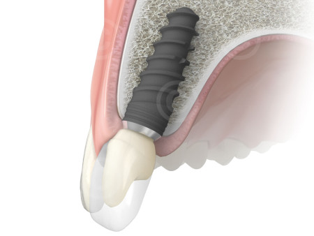 Tại sao cấy ghép implant tốt hơn so với các phương pháp khác ?