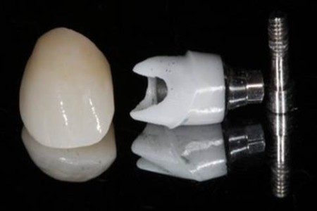 Implant_Phương pháp lý tưởng giúp phục hồi răng bị mất