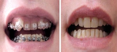 Nên chọn loại niềng răng nào là tốt nhất ?
