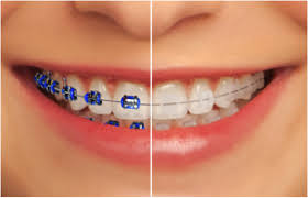 Nên chọn loại niềng răng nào là tốt nhất ?