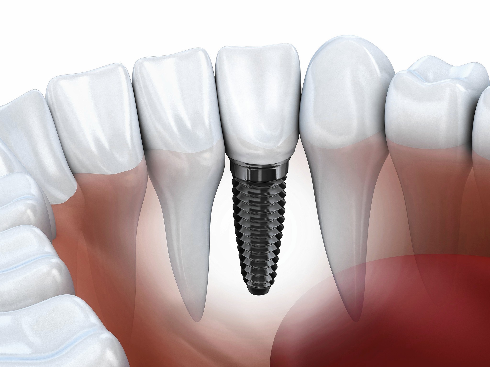 Cấy ghép răng implant có tốt không?-1