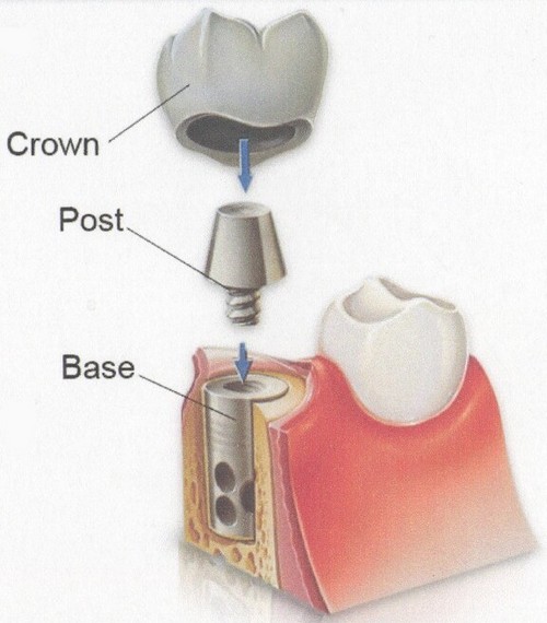 Trồng răng implant mất bao lâu 