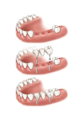 Những thế mạnh của giải pháp phục hình implant