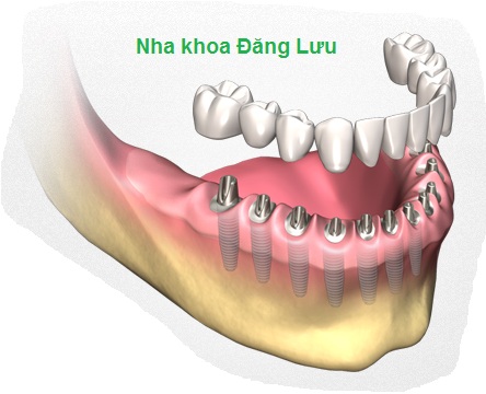 Tại sao implant là lựa chọn hàng đầu để phục hình răng?