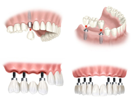 Vật liệu đạt tiêu chuẩn trong giải pháp cấy implant