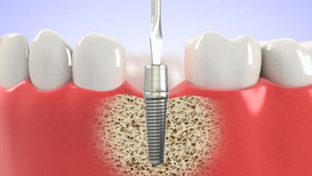 Vật liệu đạt tiêu chuẩn trong giải pháp cấy implant