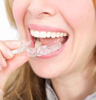 Điểm qua những ưu điểm nổi bật của phương pháp niềng răng invisalign