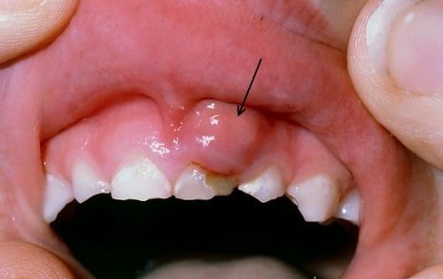 Cách trị sưng nướu răng của Nha sĩ-2