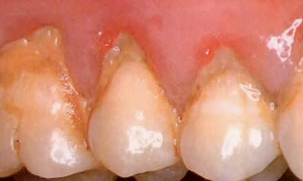Cạo vôi răng có ảnh hưởng gì không?-2