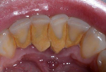 Cạo vôi răng có ảnh hưởng gì không?-3