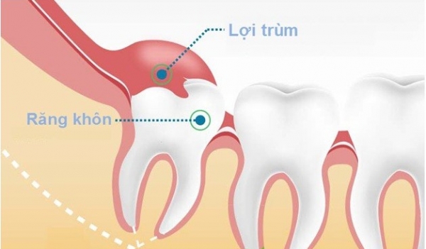 mọc răng khôn có ý nghĩa gì