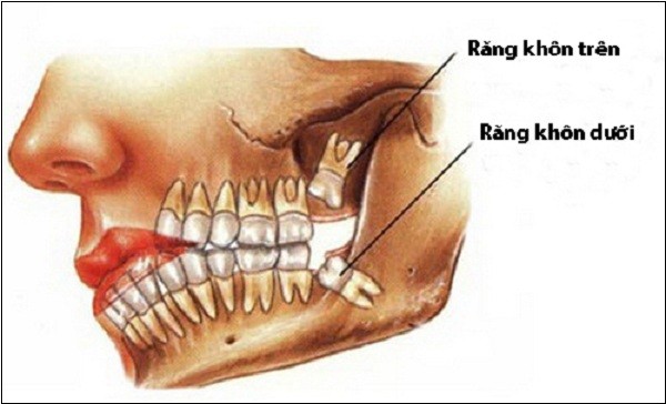 Nhổ răng khôn có nguy hiểm không