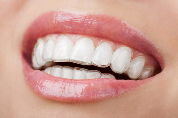 niềng răng invisalign có đau không