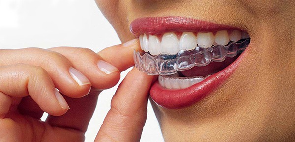 niềng răng invisalign có đau không