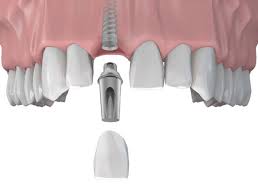 quá trình cấy ghép implant cho răng cửa
