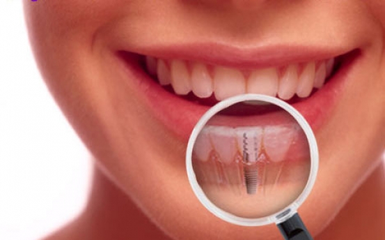 quá trình cấy ghép implant cho răng cửa