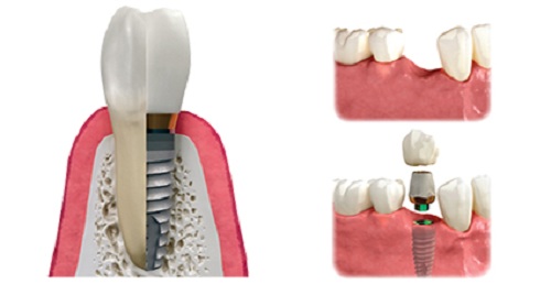 quá trình cấy ghép implant cho răng hàm