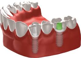 quá trình cấy ghép implant cho răng hàm