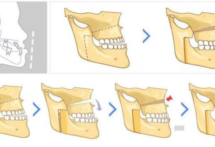 quy trình phẫu thuật hàm móm như thế nào