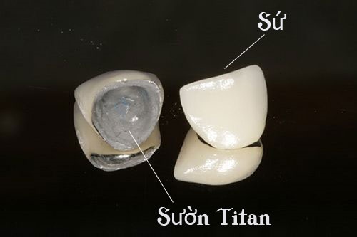 Răng sứ titan có tốt không?-1