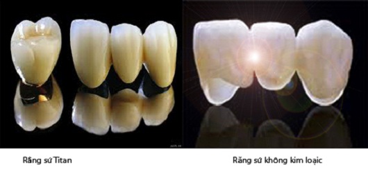 răng sứ titan giá bao nhiêu