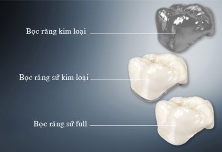 bọc răng sứ có tác hại gì không