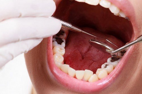 Bọc răng sứ sớm khi phát hiện răng sâu 1